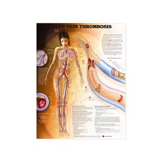 Tiefe Venenthrombose (DVT) - Planch