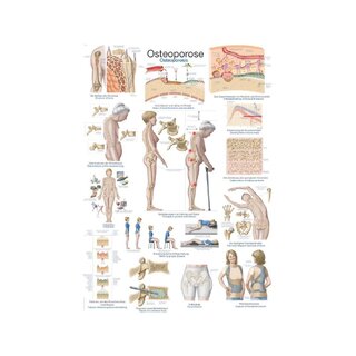 Poster Osteoporose, Anatomisches Poster 50x70cm