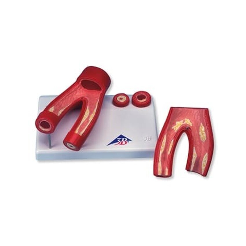 Atherosclerosis Modell mit Querschnitt der Arterie, zwei Teile