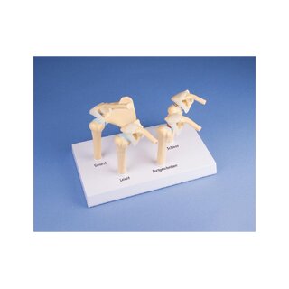 Modell 4-Stadium Osteoarthritis (OA) Schulter