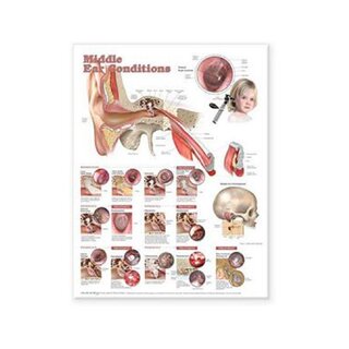 Krankheiten im mittelohrlaminierten Poster Englisch